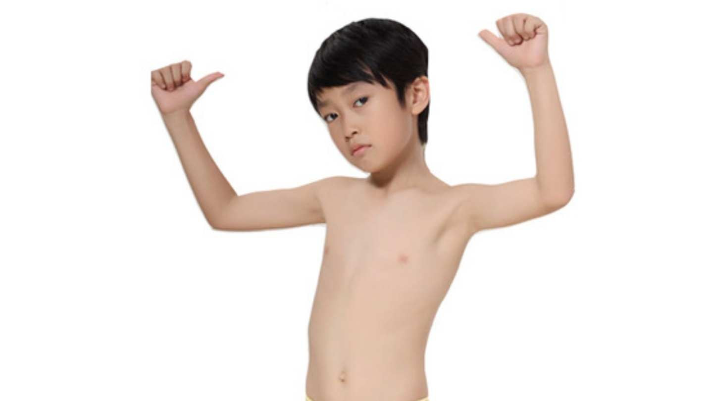 Hình ảnh minh họa bệnh còi xương ở trẻ em do thiếu canxi